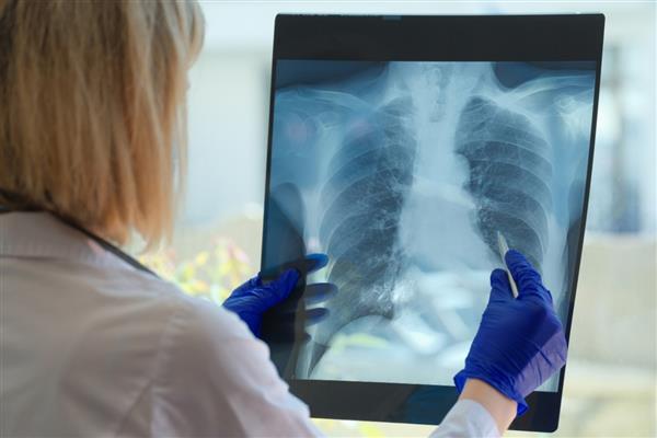 Temizlik ürünleri ve pişirme dumanı KOAH'a neden olabilir