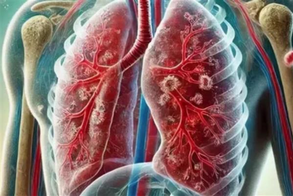 Dünya Sağlık Örgütü: Tüberküloz nedeniyle her yıl bir milyon kişi hayatını kaybediyor