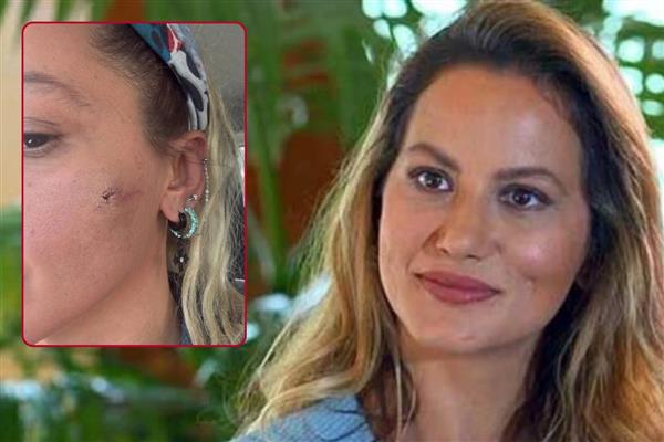 Ünlü oyuncu Yıldız Asyalı yüzündeki morlukları paylaşarak eşinden şiddet gördüğünü duyurdu